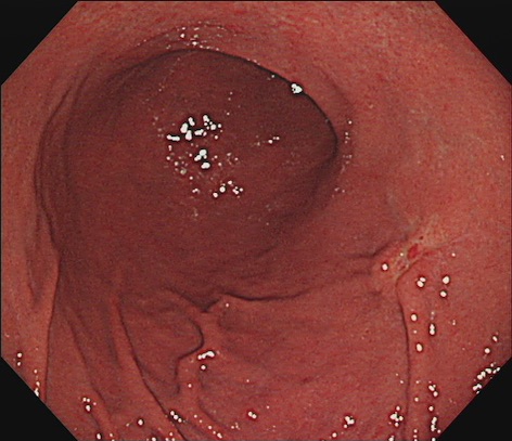 早期胃癌・内視鏡画像